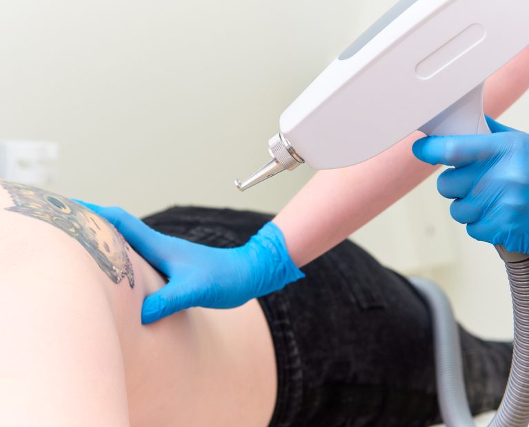 Eliminación de tatuajes cádiz